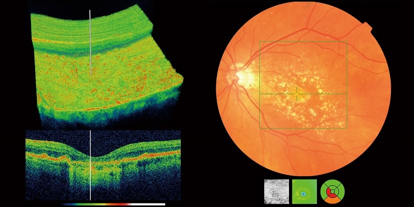 Macula-1-resize.jpg#asset:239